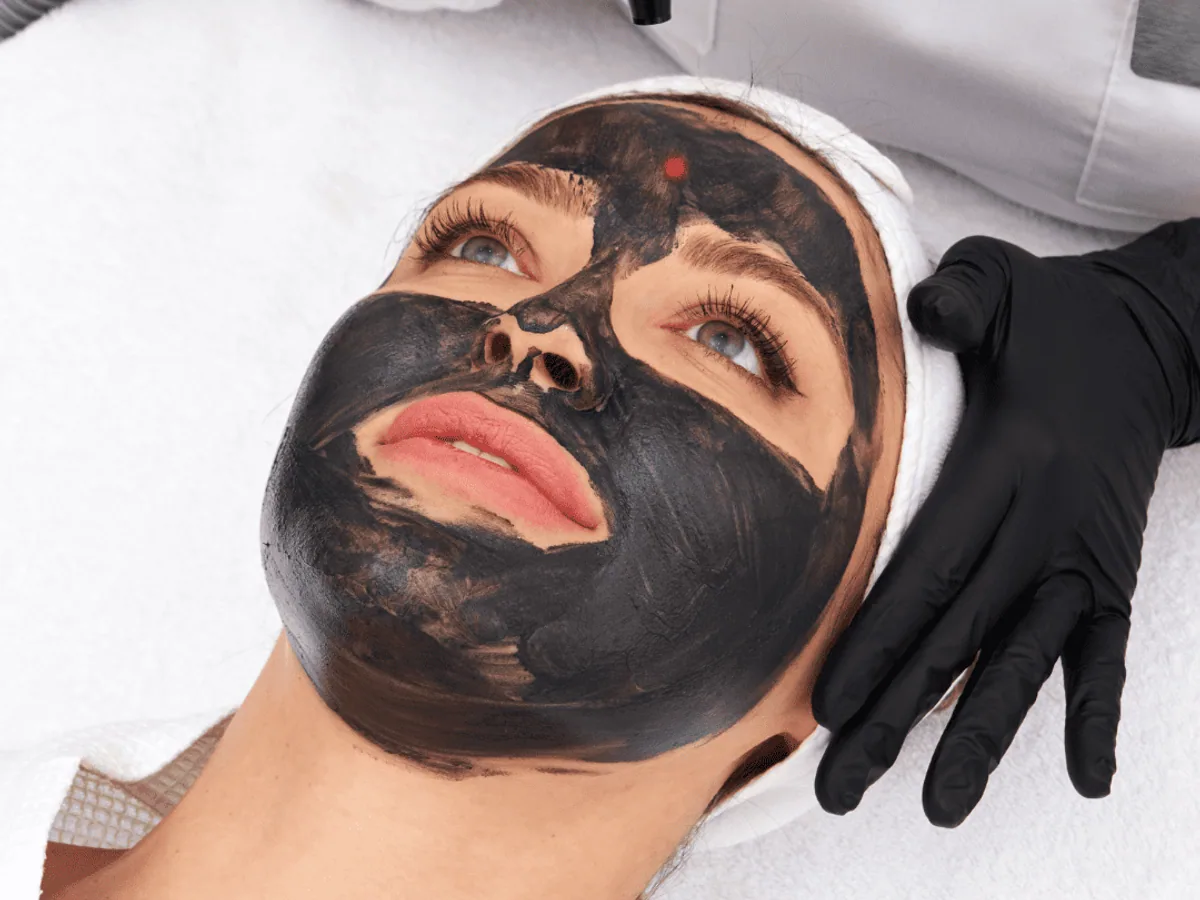 Carbon laser facial — the Hollywood Peel
