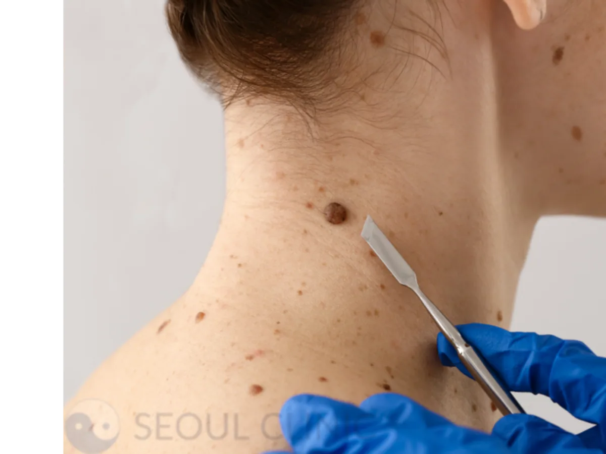 Mole Removal